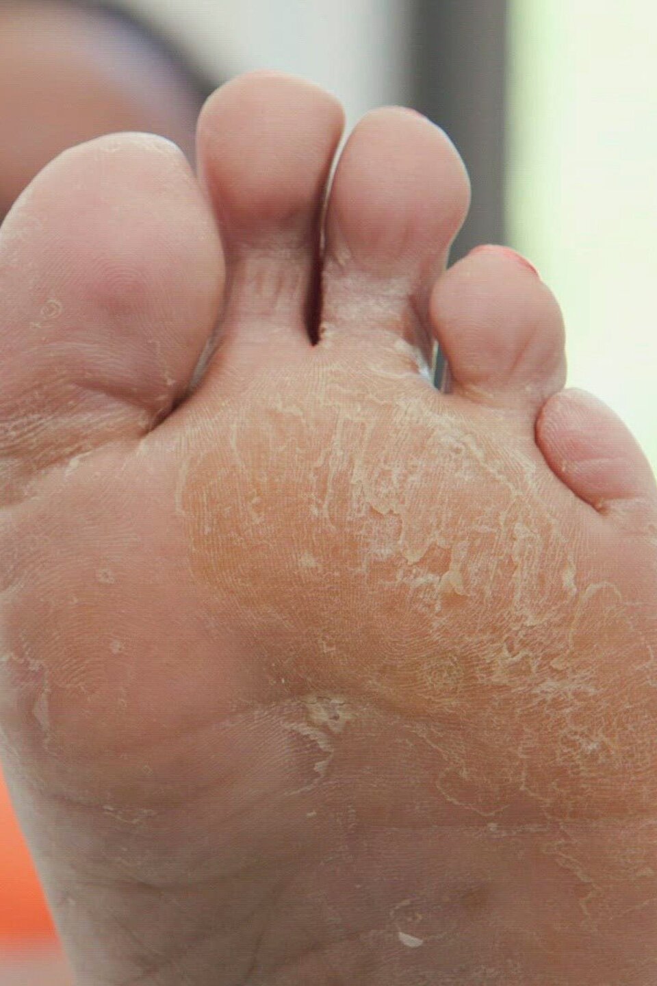 My Foot Looks Like Parmesan Cheese! Pictures Rotten Tomatoes